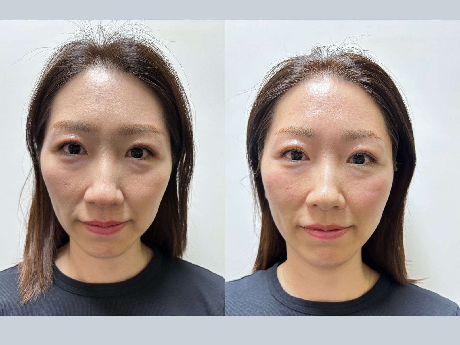 美容鍼パルス施術前後の比較（本人公開許可済み）
