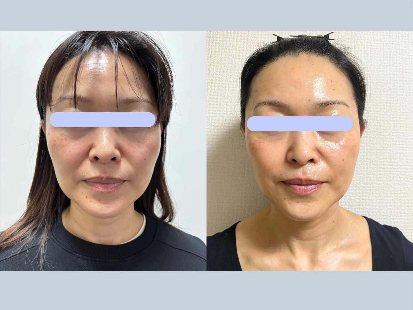 幹細胞ダーマ鍼施術前後の比較（プライバシー保護のため目元を加工）